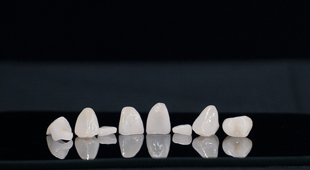 E-Max & Composite Veneers